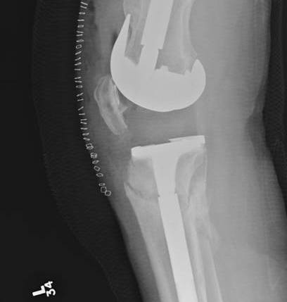 Periprosthetic TKR Tibial Fracture 3